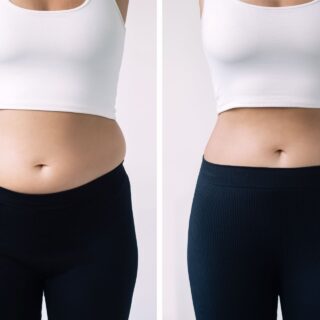 cryolipolysis mini
