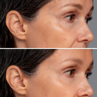 fractional laser mini dietsystem.gr (1) fractional laser