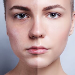 fractional laser mini dietsystem.gr (4) fractional laser