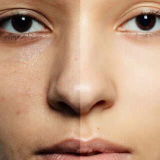 fractional laser mini dietsystem.gr (6) fractional laser